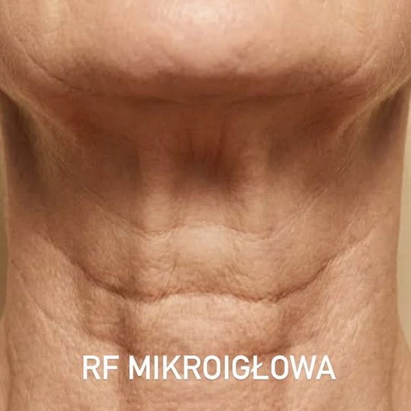 Skóra szyi przed zabiegiem radiofrekwencji mikroigłowej